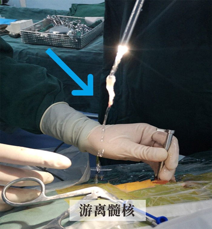 游離髓核.jpg